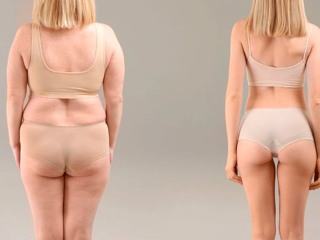 remodelacion-corporal