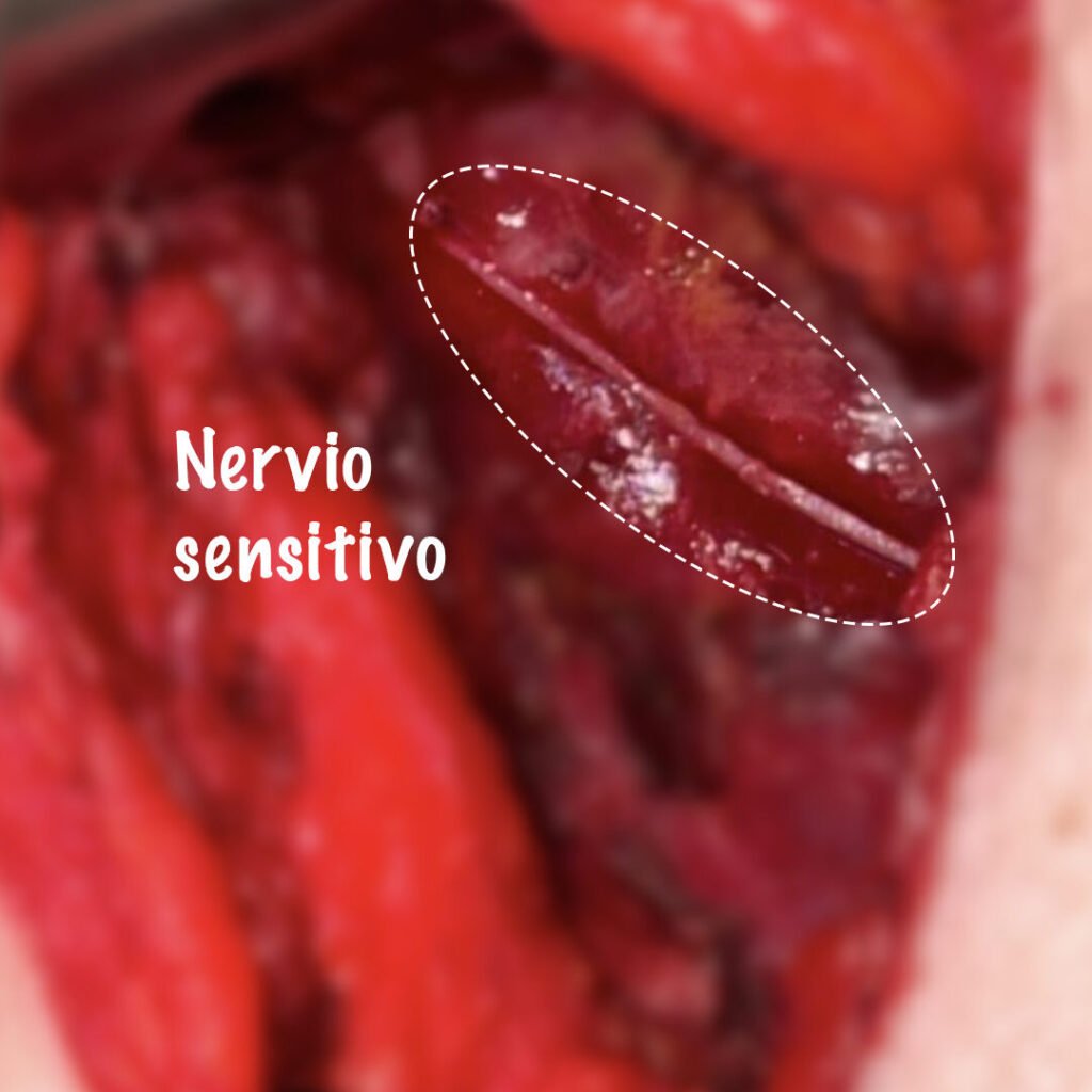 nervio-sensitivo-dolor-neuropatico